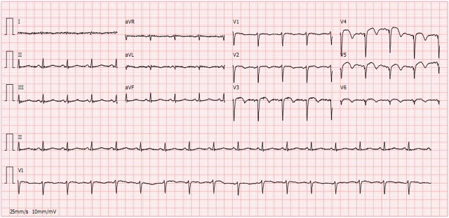 Pinkie Tuskaderro ekg